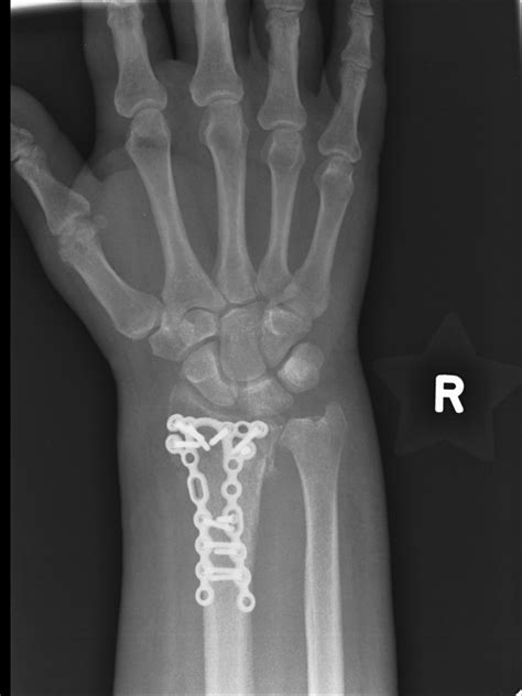 cnc machine wrist fracture|wrist fracture pain relief.